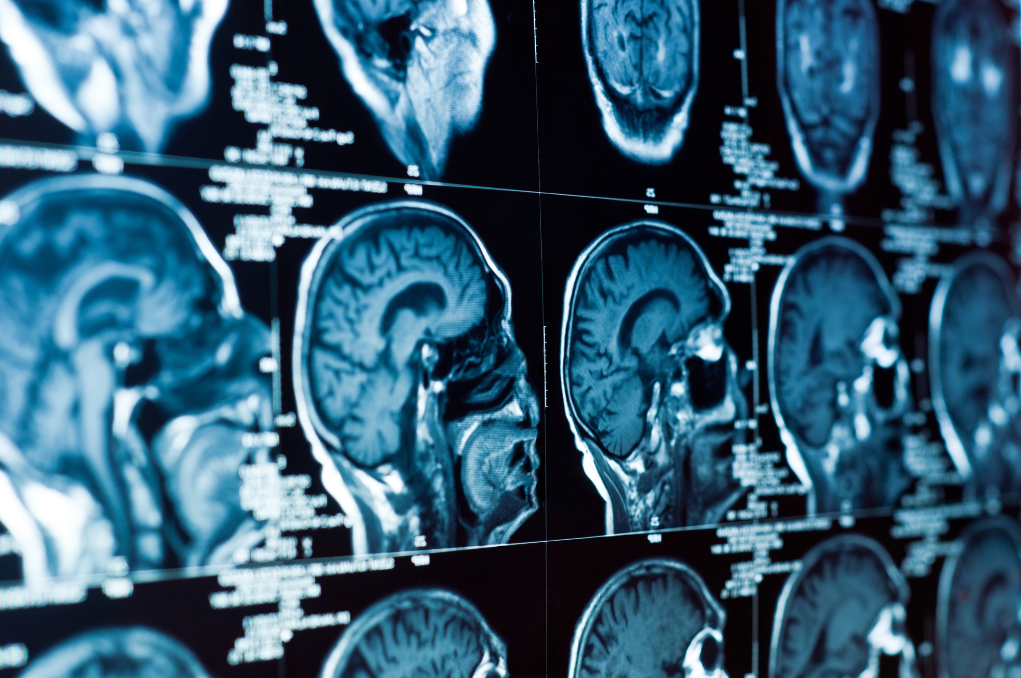 When Do You Need a Brain Injury/Spinal Injury Lawyer?